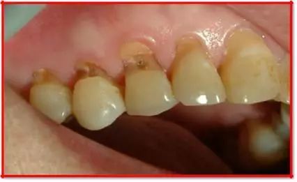 還在這樣刷牙嗎？當心楔狀缺損找上門！